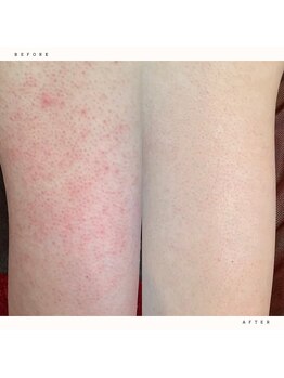 イチロクイチハチ(1618)/二の腕のポツポツ 症例紹介