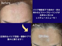 ベリル(BERYL)/敏感肌でも諦めないで！！