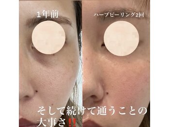 リツイート(ReTweet)/ハーブピーリング・艶・くすみ