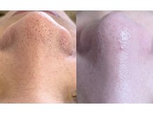 ユフラ(Juhla)/韓国3D毛穴洗浄