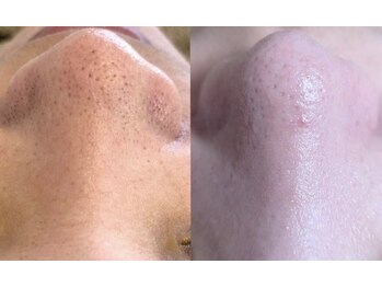 ユフラ(Juhla)/韓国3D毛穴洗浄