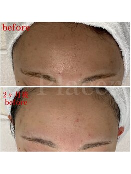 プラセル(Placer)/おでこのくすみもスッキリ