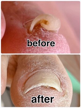 巻き爪ケアセンター 横須賀/巻き爪before⇒after