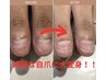 期間限定！誰にもバレずに深爪矯正モニター様募集【自爪風仕上げ】