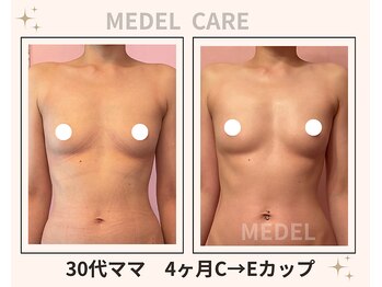 メデル 北千住店/バストアップ*育乳症例