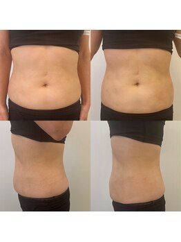 ホロニック ベルサンテ(Holonic Belle Sante)/脂肪/引き締め/サイズダウン