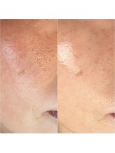 サロンドジョリー/ハーブピーリング