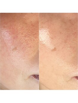 サロンドジョリー/ハーブピーリング