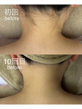サロンドジェシカ(salon de Jessica)/うなじ脱毛