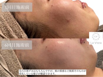 ラヴィオーラ 福島野田店(La Viora)/ダイヤモンドハーブピーリング