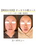 -初回- 【韓国水光肌カーボキシー】すっきり小顔コース80分　￥9,800→￥5500