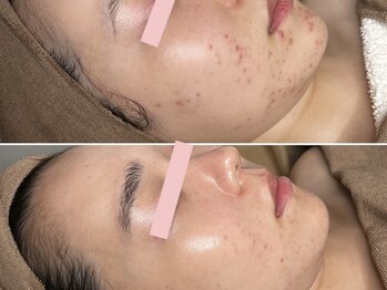 エイプリルフールズ(April fools)/【20代】繰り返す口周りのニキビ