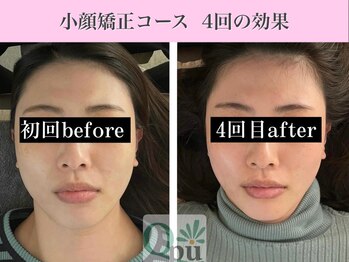 キュープ 表参道店(Qpu)/小顔矯正4回コースの変化