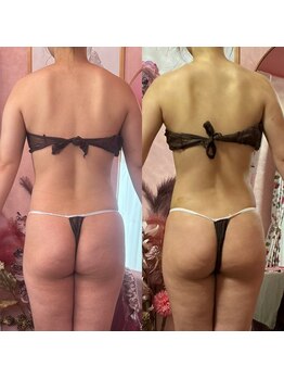 ポノ(Pono)/スッキリとした背中美人へと☆