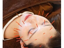 鍼灸院ワタナベコウヘイ(Watanabe Kohei)/症状に合わせた鍼！