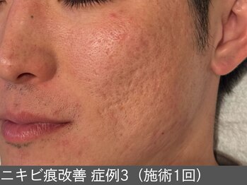 オアシスラグーン(OASIS LAGOON)/ニキビ後の凹凸(症例3施術1回)