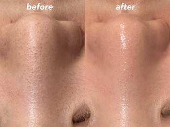 インク(ink)/ハイドロ×スノーピーリング