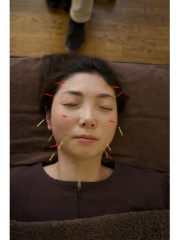 ビューティーパンク 黒田鍼治療院(Beauty Punc)/8.お顔の鍼はこんな感じ