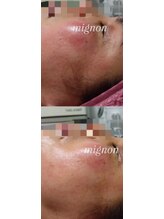 サロンド エステ ミニョン(salon de esthe mignon)/ガリレオ☆施術前から1回目後