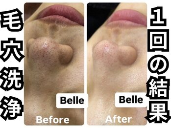 ベル 心斎橋店(Belle)/毛穴洗浄1回