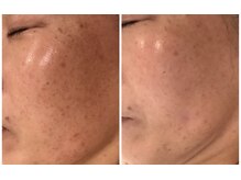 リュウ鍼灸院 サロン ド リュウ(Salon de Ryu)/シミメアでの改善例