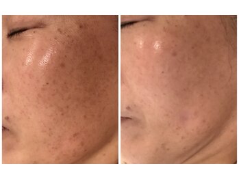 リュウ鍼灸院 サロン ド リュウ(Salon de Ryu)/シミメアでの改善例