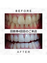 エミリアホワイトニング(EMIRIA WHITENING)/Before/After