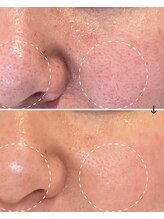 サロン モジョ(mojo)/プラズマレーザートーニング