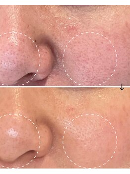 サロン モジョ(mojo)/プラズマレーザートーニング