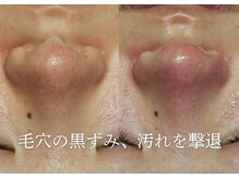 アマランサス(Amaranthus)/黒ずみ、ざらつき、徹底オフ