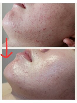 ベビースキン(baby skin)/ニキビ肌改善