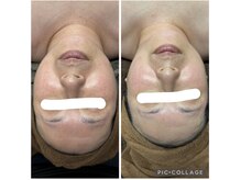 テラスアップ(Terrace UP)/【脂肪分解マシン】フェイシャル