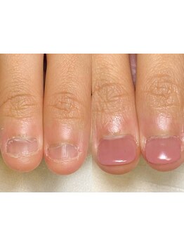 爪の悩みを解消できる（ケア含む）