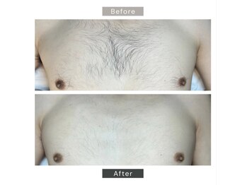 シーボウ(CBOU)/美容電気脱毛(胸毛)