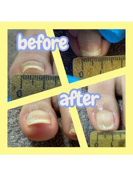 巻き爪ケア&クリア仕上げ