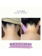 ベベ(Bebe)/うなじ脱毛♪
