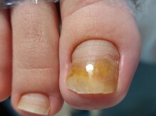 爪切り屋 足楽/新旧世代交代◆段差のできた爪