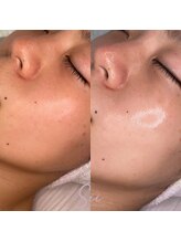 エマ(ema)/水光生美容液導入トリートメント