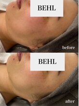 ベール(BEHL)/ジェリーマスクのBefore After