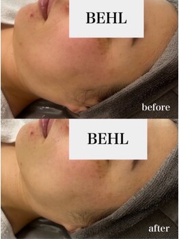 ベール(BEHL)/ジェリーマスクのBefore After