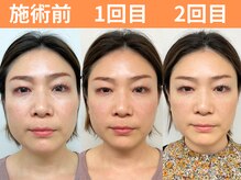 ナチュラルビューティーフェイス 横浜(NBF)/小顔矯正/ビフォーアフター