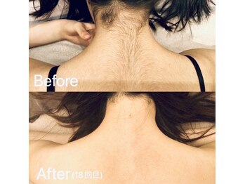 ネムレル森(Nemureru森)/脱毛【水巻/中間/八幡西区】