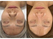 レイ(Lei)/ニキビ/毛穴/ハーブピーリング