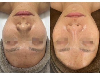 レイ(Lei)/ニキビ/毛穴/ハーブピーリング