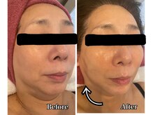 ブランシュール/小顔タイト×MTメタトロン &nbsp;