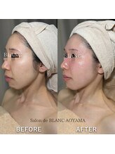 サロン ド ブラン アオヤマ(Salon de BLANC AOYAMA)/毛穴ケアもほうれい線ケアも叶う
