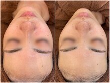 アプリ(APRI)の雰囲気（肌質改善　乾燥　赤み　毛穴　ザラつき）