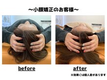 トータルビューティーみつとも/小顔矯正/インディバ/EMS