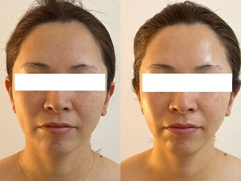 シアワセ(shiAwase)/【大阪本町】小顔矯正 B/A変化