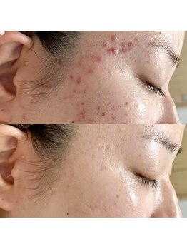 ウイユ(Oeil)/剥けるハーブピーリング 効果7回